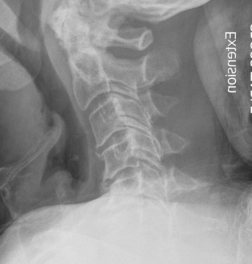 Cervical Stenosis Kyphotic Alignment
